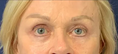 Brow Lift Case #3108 — after, Dr. Arjun Kanuri