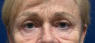 Brow Lift Case #3108 — before, Dr. Arjun Kanuri