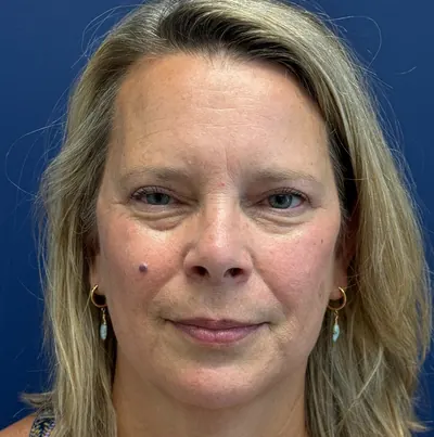 Eyelid Surgery Case #13622 — after, Dr. Samir Rao