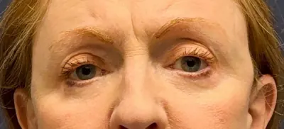 Eyelid Surgery Case #2019 — after, Dr. Arjun Kanuri