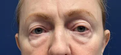 Eyelid Surgery Case #2019 — before, Dr. Arjun Kanuri