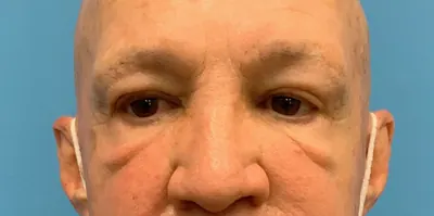 Eyelid Surgery Case #24169 — before, Dr. Arjun Kanuri
