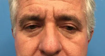 Eyelid Surgery Case #288 — after, Dr. Samir Rao