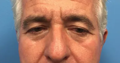 Eyelid Surgery Case #288 — before, Dr. Samir Rao