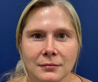 Eyelid Surgery Case #29601 — after, Dr. Samir Rao