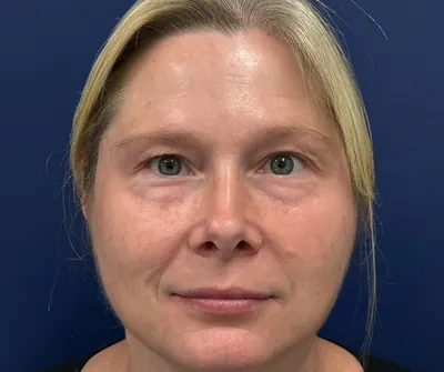 Eyelid Surgery Case #29601 — before, Dr. Samir Rao