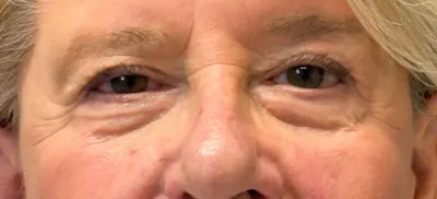 Eyelid Surgery Case #3336 — after, Dr. Arjun Kanuri