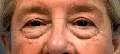 Eyelid Surgery Case #3336 — before, Dr. Arjun Kanuri