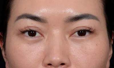 Eyelid Surgery Case #356 — after, Dr. Arjun Kanuri