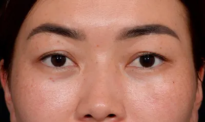 Eyelid Surgery Case #356 — before, Dr. Arjun Kanuri