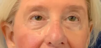 Eyelid Surgery Case #4349 — after, Dr. Arjun Kanuri