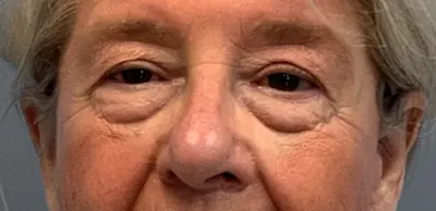 Eyelid Surgery Case #4349 — before, Dr. Arjun Kanuri