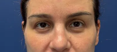 Eyelid Surgery Case #5118 — after, Dr. Arjun Kanuri