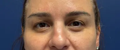 Eyelid Surgery Case #5118 — before, Dr. Arjun Kanuri