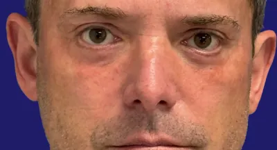 Eyelid Surgery Case #5888 — after, Dr. Frank Albino