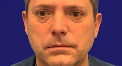 Eyelid Surgery Case #5888 — before, Dr. Frank Albino