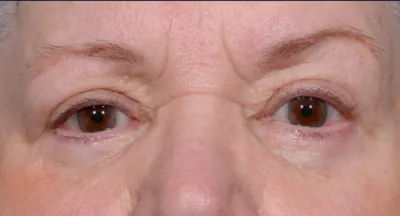 Eyelid Surgery Case #6005 — after, Dr. Arjun Kanuri