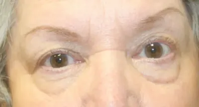 Eyelid Surgery Case #6005 — before, Dr. Arjun Kanuri