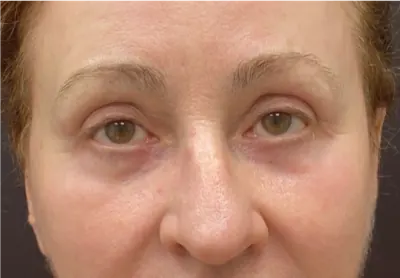 Eyelid Surgery Case #9685 — after, Dr. Arjun Kanuri