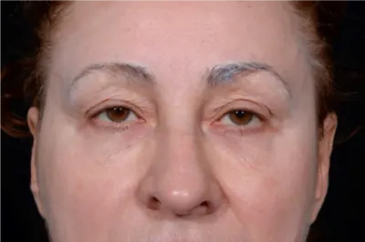 Eyelid Surgery Case #9685 — before, Dr. Arjun Kanuri