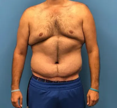 Body Lift Case #2 — after, Dr. Samir Rao