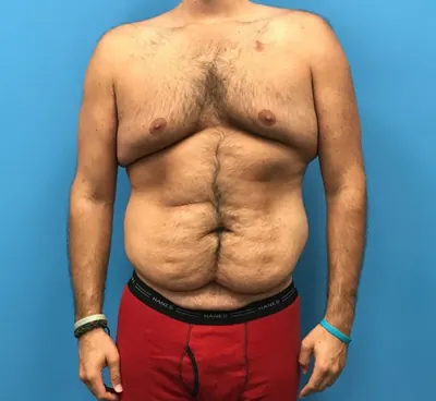 Body Lift Case #2 — before, Dr. Samir Rao