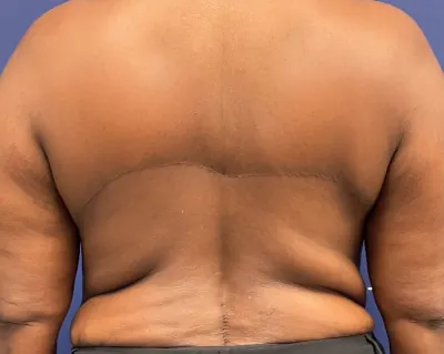 Body Lift Case #3 — after, Dr. Samir Rao