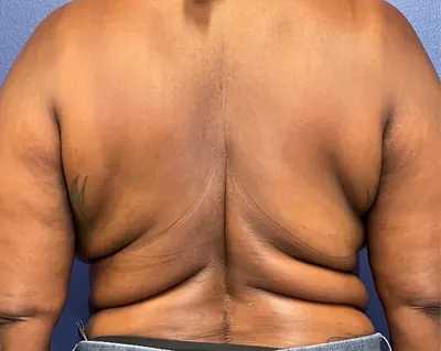 Body Lift Case #3 — before, Dr. Samir Rao