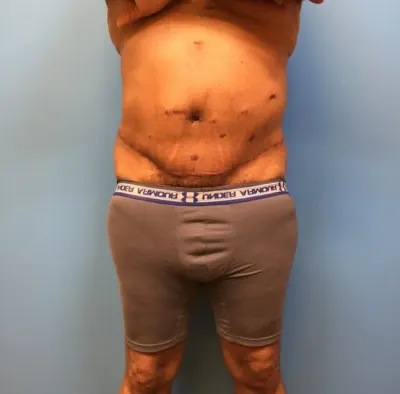 Body Lift Case #body-lift-before-and-after — after, Dr. Samir Rao