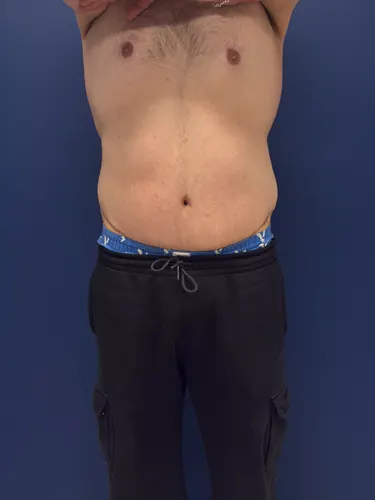 Body Lift Case #1927 — after, Dr. Samir Rao
