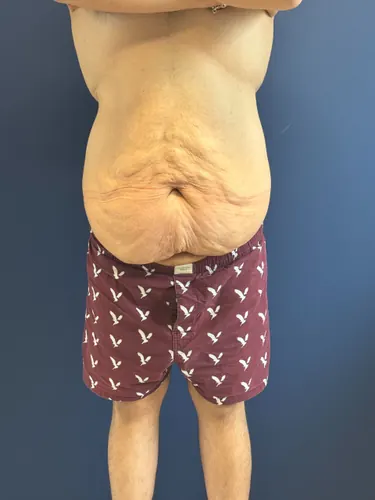 Body Lift Case #1927 — before, Dr. Samir Rao
