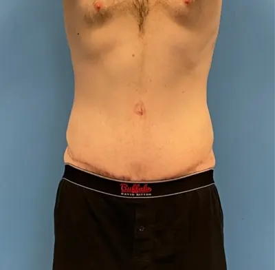 Tummy Tuck Case #273 — after, Dr. Samir Rao