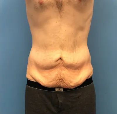 Tummy Tuck Case #273 — before, Dr. Samir Rao
