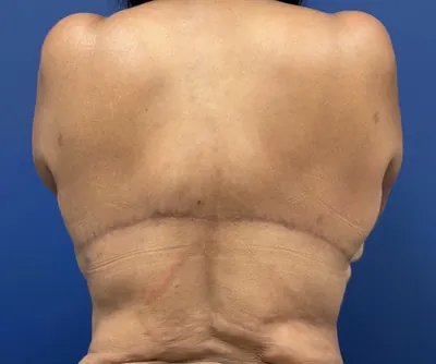 Body Lift Case #body-lift — after, Dr. Samir Rao