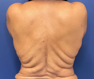 Body Lift Case #body-lift — before, Dr. Samir Rao