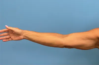 Arm Lift Case #26141 — after, Dr. Samir Rao