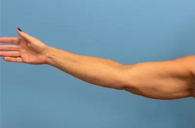 Arm Lift Case #26141 — before, Dr. Samir Rao