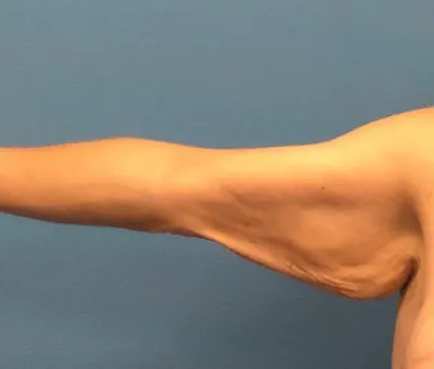 Arm Lift Case #18182 — before, Dr. Samir Rao