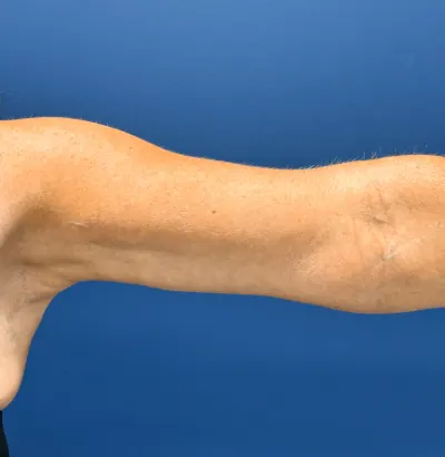 Arm Lift Case #2564 — after, Dr. Frank Albino