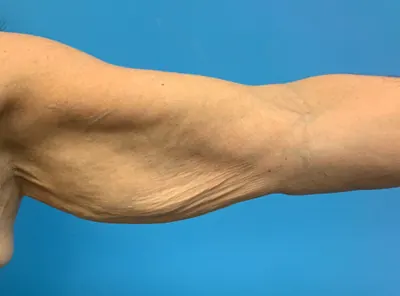 Arm Lift Case #2564 — before, Dr. Frank Albino