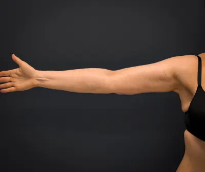 Arm Lift Case #3119 — after, Dr. Samir Rao