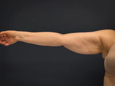 Arm Lift Case #3119 — before, Dr. Samir Rao