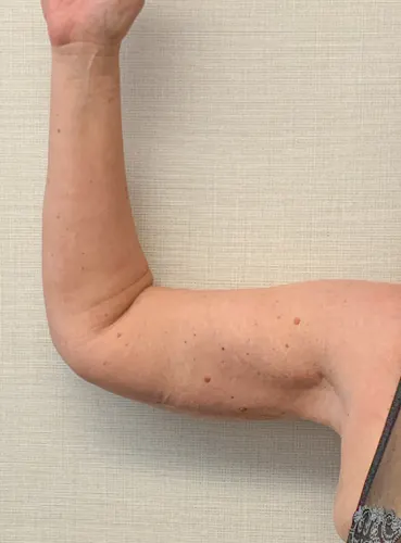 Arm Lift Case #3168 — after, Dr. Frank Albino