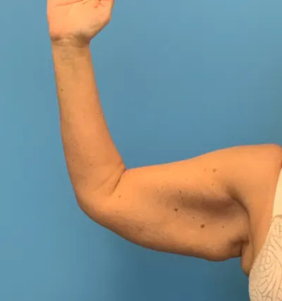 Arm Lift Case #3168 — before, Dr. Frank Albino