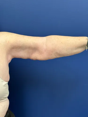 Arm Lift Case #3447 — after, Dr. Frank Albino