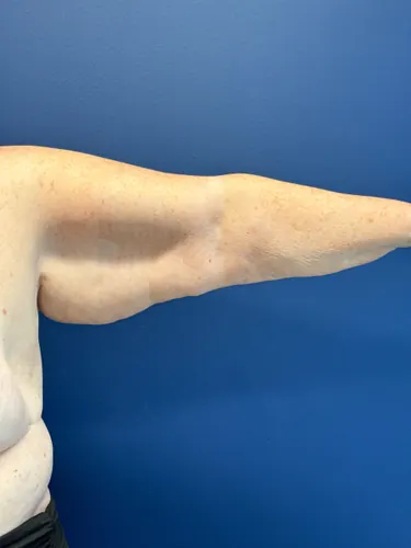 Arm Lift Case #3447 — before, Dr. Frank Albino