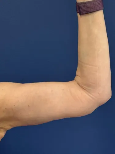 Arm Lift Case #3625 — after, Dr. Frank Albino