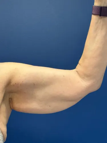 Arm Lift Case #3625 — before, Dr. Frank Albino