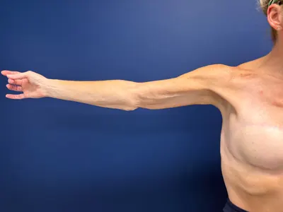 Arm Lift Case #3898 — after, Dr. Samir Rao