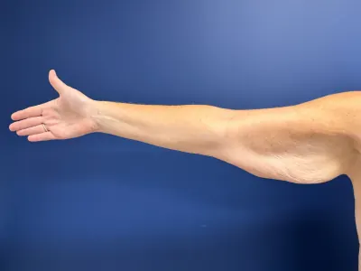 Arm Lift Case #3898 — before, Dr. Samir Rao